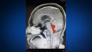 Tapeworm removed from Texas man&rsquo;s brain after months of headaches
