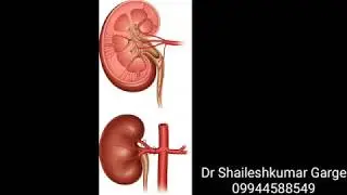 Embolisation of right renal artery branch | Coil Embolisation | Bleeding Embolisation in hyderabad