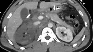 Renal artery to IVC fistula
