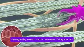 ✨ Stretch Marks DO Have a Solution &ndash; Discover the Most Complete Treatment at BalanceMedSpa