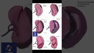 Splenic Laceration Grading Explained in 60 Seconds #trauma  #emergencymedicine #pediatrics #meded