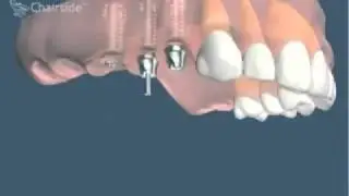Implants dentaires et bridge sur implants pour remplacer plusieurs dents