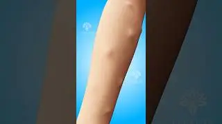 Why Do Lipomas Form Under Your Skin #shorts #viralvideo #lipomas - Creativelearning3d