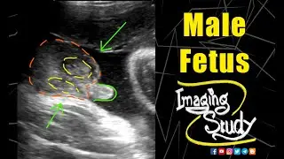 Male Fetus - 36+ Week || Ultrasound || Case 186