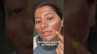 Chemical peel for acne scars ,texture ✨ The peeling phase was real&hellip; but this glow? Worth every flake