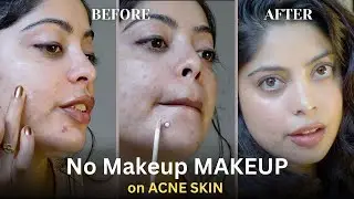 STOP Hiding Behind Heavy Foundation Learn How to Do NO MAKEUP MAKEUP look on Acne Skin!