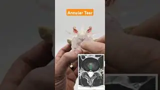 Annular Tear Model by Dynamic Disc Designs