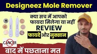 Designeez Electric Freckle Skin Mole Dark Spot Remover Review | How to Use | Side Effects