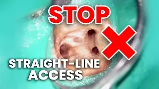 Why Orifice Directed Access Beats Straight-Line in Root Canals