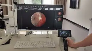 Portable fundus camera with  CMN systems