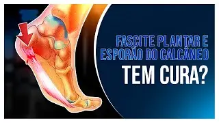 FASCITE PLANTAR E ESPORÃO DO CALCÂNEO TEM CURA? APRENDA NESSE VÍDEO!