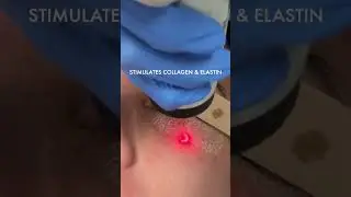 CO2 Laser For Under Eye Rejuvenation