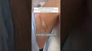 #hairremoval #laser #skincare #laserskincare #sopranoice #laserface #fyp #beautylaserstudio