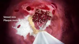 Philips IVUS in peripheral arterial disease (PAD)