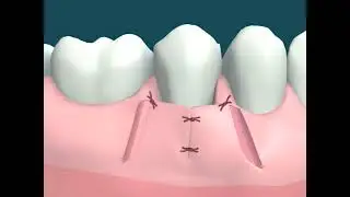Dental Video of Lateral Pedicle Graft of Lower Premolar