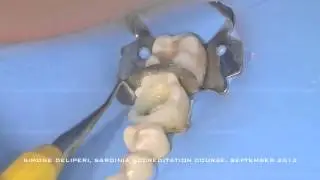 Dr Simone Deliperi: Fiber reinforced Stress Reduced Direct Composite (FR SRDC) restorations