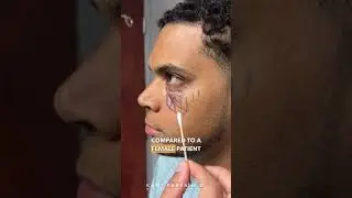 Lower Eye Bag Removal For Males with Dr. Kami Parsa | Trifecta Lift