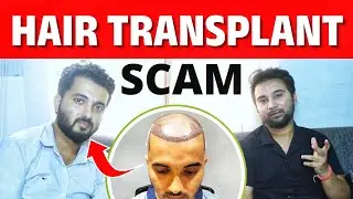 Hair Transplant Cost Scam In 2025🔥🔥🔥 Low Cost Vs. High Cost Hair Transplant Result