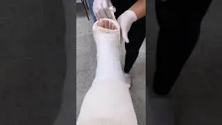Clip 60 Put CAST Slc cast woman Engessada enyesada escayolada
