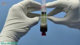 Reclaiming Life with PRP Therapy &ndash; Insights by Dr. Ashish Singh