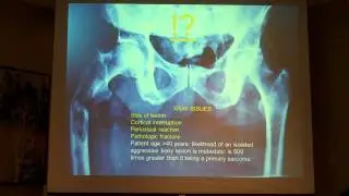Pathologic Fracture of the Femur from Metastatic Bone Disease