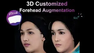Fitme 3D Customized Forehead Silicone Implant By SLC