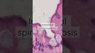 Intestinal Spirochaetosis - Pathology #shorts