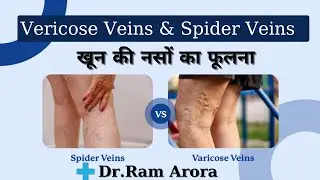 Vericose Veins & Spider Veins/ खून की नसों का फूलना / #drramarora #ayurveda #ayurvedatreatment