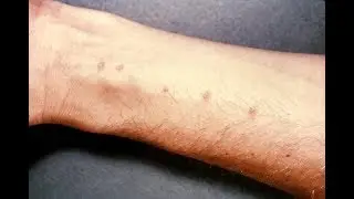 An introduction to Swimmer's itch