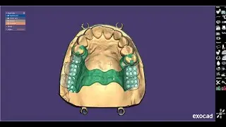 EXOCAD PartialCad  Один из многих бюгельных протезов