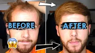 Going bald at 25! | How I style my thinning, receding hair