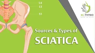 Sources and Types of Sciatica | Sciatica | MJ Physio