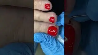 ВРОС НОГОТЬ И ЗАГНОИЛСЯ ПАЛЕЦ! ЧТО ДЕЛАТЬ? ЧЕМ ПОКРЫТЬ НОГОТЬ НА НОГЕ ЕСЛИ ОН ВРОС В БОКОВОЙ ВАЛИК?