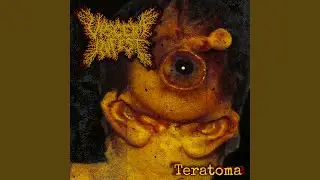 Teratoma