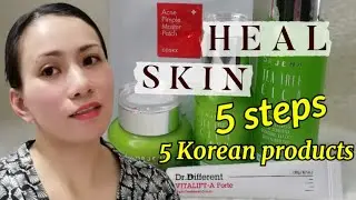 SKIN EMERGENCY: 5 PRODUCTS I USED TO TREAT MY HORMONAL ACNE/PIMPLE | Gandang Filipina sa Espa&ntilde;a