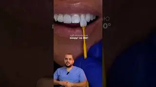 ЧЕМ ОТЛИЧАЕТСЯ КОРОНКА ОТ ВИНИРА? #стоматолог #dentist #доктор #зубы #виниры #коронка