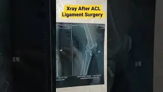 Post ACL Reconstruction Xray | ACL Ligament Screw & Button | लिगामेंट स्क्रू और बटन| #aclsurgery  &bull;