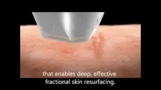 TriFractional Anti Aging Fractional RF Skin Treatment