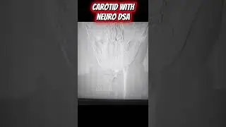 Neuro and Carotid DSA #radiology #cathlab #angiography #angiogram #neurology #vascularsurgeon