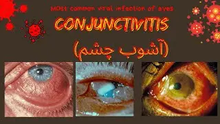 Ashob e Chasm | Conjunctivitis | Causes | Prevention & Treatment | Signs | symptoms