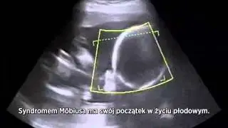 Discovery Channel - Nie do uwierzenia - Zastygła twarz