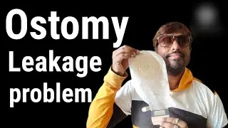How to prevent Ostomy leakage | Colostomy Leakage problem solved | Stoma leakage problem