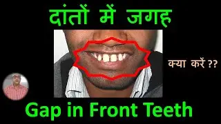 HOW TO CORRECT GAP IN FRONT TEETH, दांतों के बीच में जगह को कैसे ठीक करें.