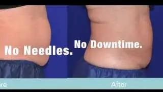 CoolSculpting Before and After Pics, Fat Freezing Results Los Angeles