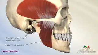 TMJ Disorder or TMD - Pain Due to Malocclusion