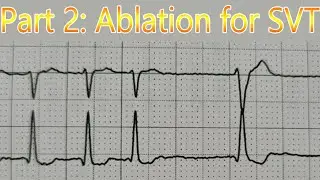 ABLATION for AVNRT-Supraventricular Tachycardia (SVT) and moving on. [Part 2]