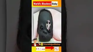 World's blackest baby,|दुनिया का सबसे black बच्चा,| #shorts #ashortaday