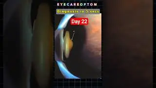👁️&zwj;🗨️Visual Diagnosis DAY 22 | Guess the condition? #eyecare #optometry #lens #shorts