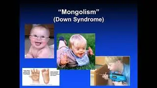 Autism Spectrum Disorder in 3D, Post 2: Langdon Down