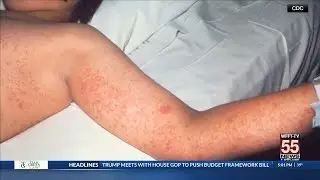 Doctors weigh in on how to prevent Measles from spreading